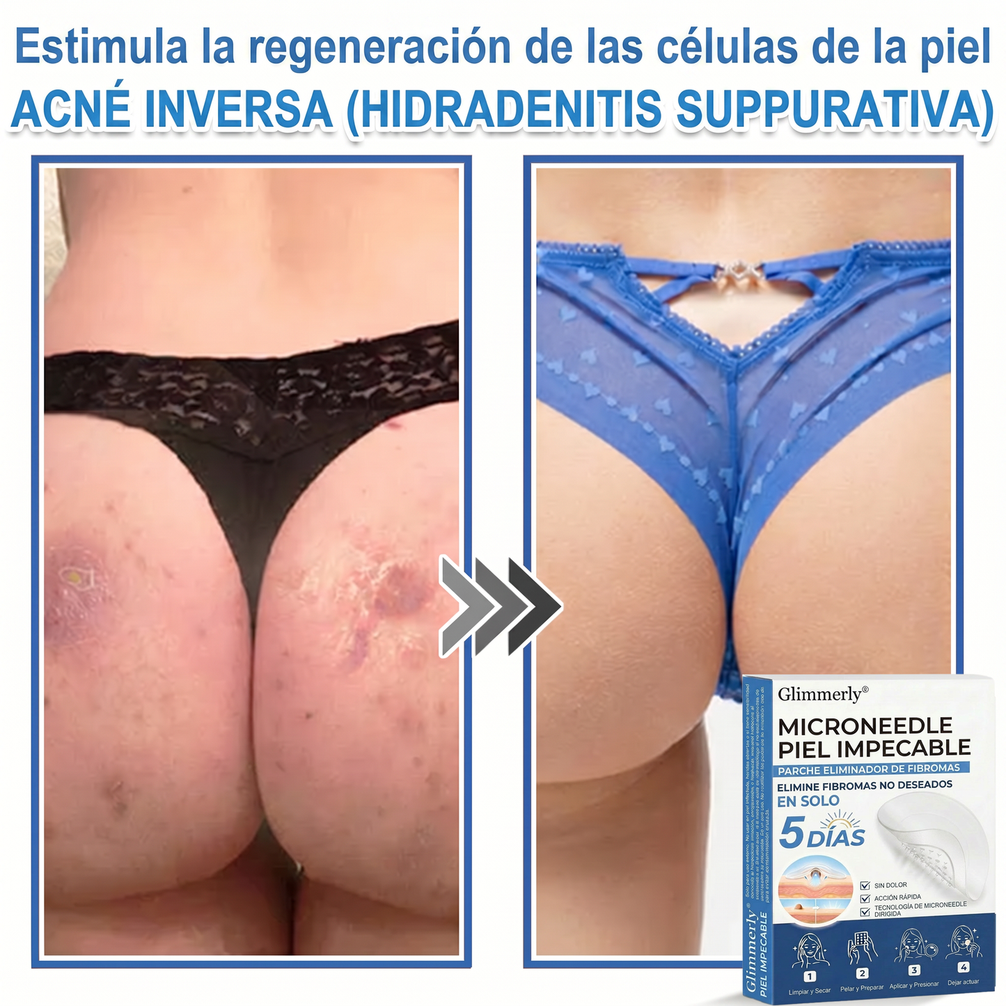 OnyCure v3™ — La luz LED azul que por fin llega al hongo bajo la uña, para volver a enseñar los pies este verano (sesiones de 7 min en casa · 30 días de garantía · incluye aceite natural GRATIS)