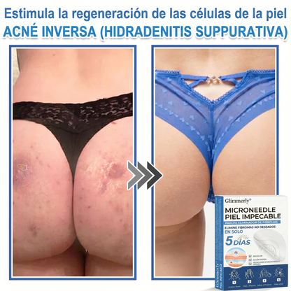 OnyCure v3™ — La luz LED azul que por fin llega al hongo bajo la uña, para volver a enseñar los pies este verano (sesiones de 7 min en casa · 30 días de garantía · incluye aceite natural GRATIS)