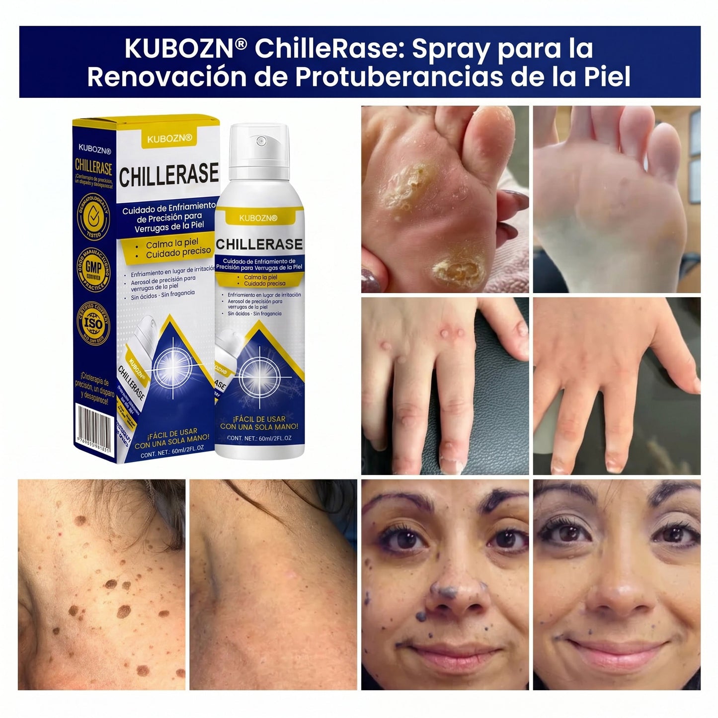 🇸 KUBOZN®ChillErase Spray de Renovación contra Protuberancias