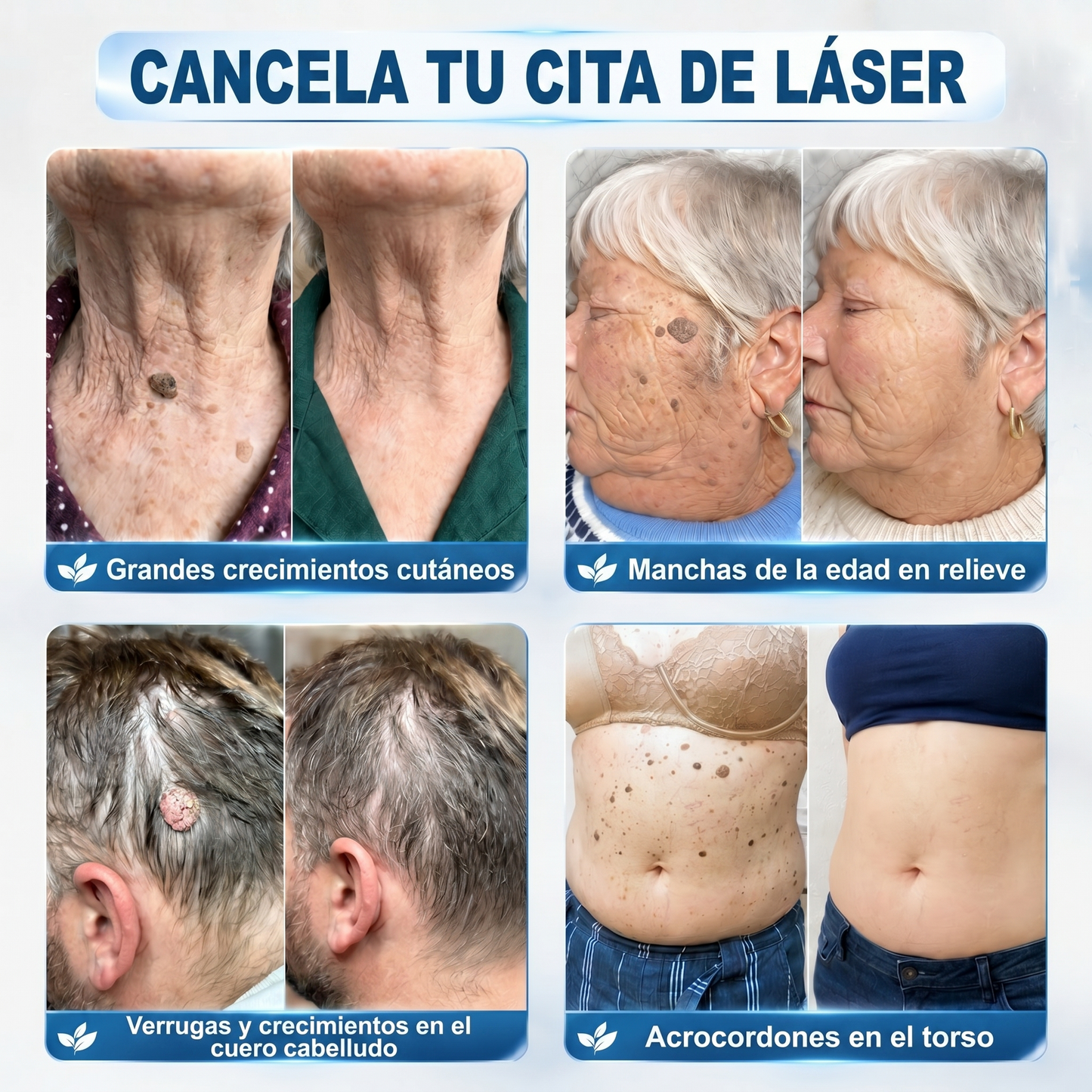 ✒️𝐏𝐢𝐜𝐝𝐨® 𝐁𝐨𝐫𝐫𝐚𝐝𝐨𝐫 𝐝𝐞 𝐕𝐞𝐫𝐫𝐮𝐠𝐚𝐬 𝐲 𝐌𝐚𝐧𝐜𝐡𝐚𝐬 𝐝𝐞 𝟕 𝐃í𝐚𝐬 (Aplicador roll-on: sin dolor ni cicatrices)