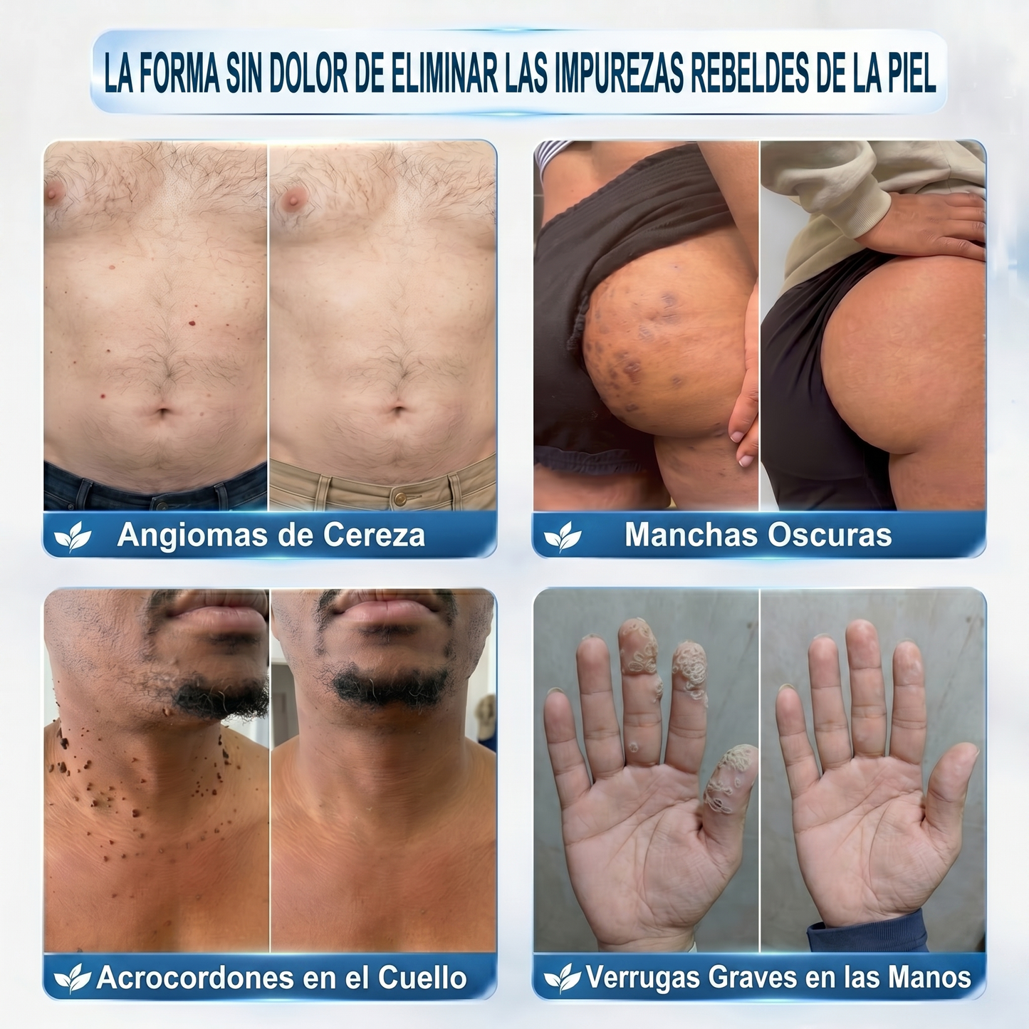 ✒️𝐏𝐢𝐜𝐝𝐨® 𝐁𝐨𝐫𝐫𝐚𝐝𝐨𝐫 𝐝𝐞 𝐕𝐞𝐫𝐫𝐮𝐠𝐚𝐬 𝐲 𝐌𝐚𝐧𝐜𝐡𝐚𝐬 𝐝𝐞 𝟕 𝐃í𝐚𝐬 (Aplicador roll-on: sin dolor ni cicatrices)