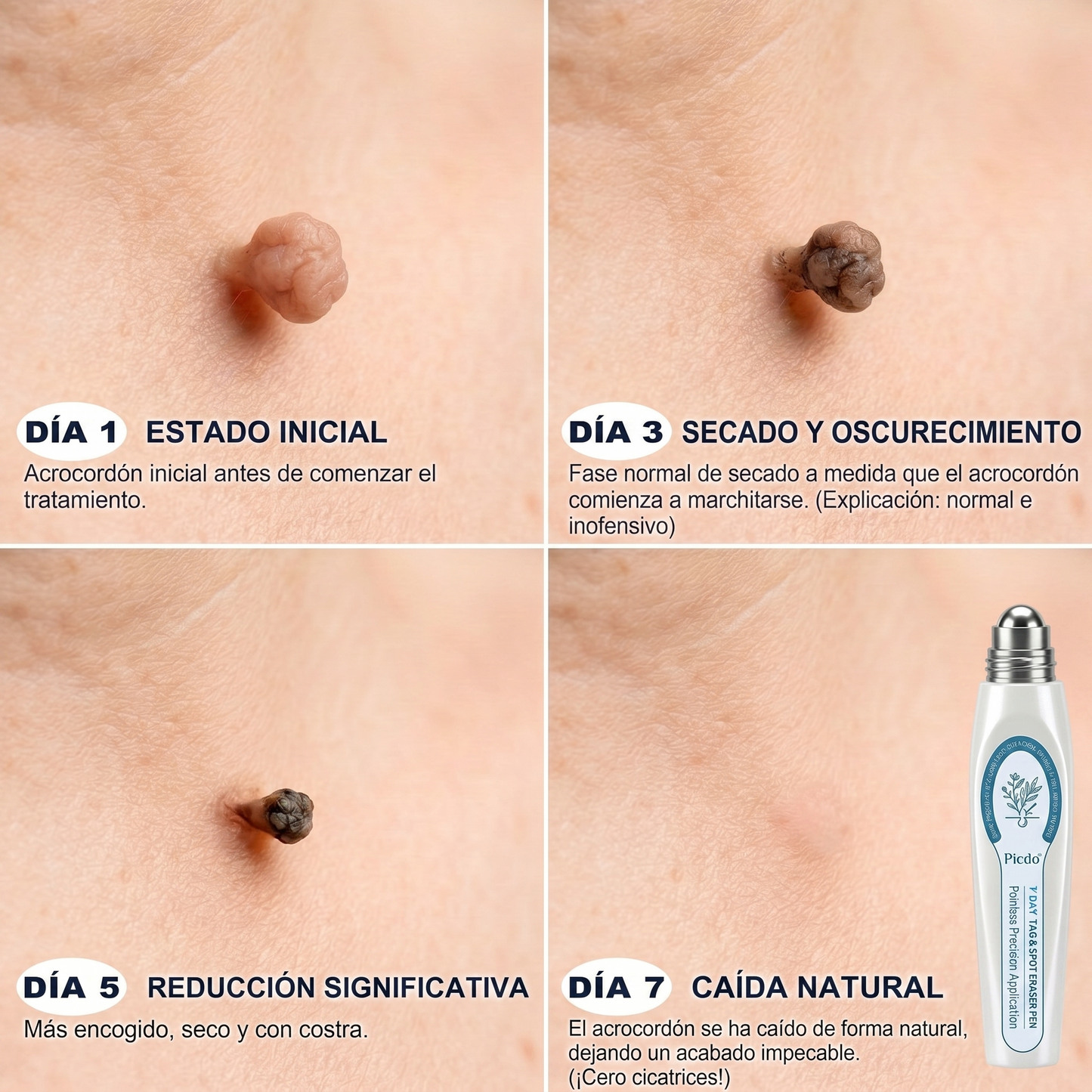 ✒️𝐏𝐢𝐜𝐝𝐨® 𝐁𝐨𝐫𝐫𝐚𝐝𝐨𝐫 𝐝𝐞 𝐕𝐞𝐫𝐫𝐮𝐠𝐚𝐬 𝐲 𝐌𝐚𝐧𝐜𝐡𝐚𝐬 𝐝𝐞 𝟕 𝐃í𝐚𝐬 (Aplicador roll-on: sin dolor ni cicatrices)