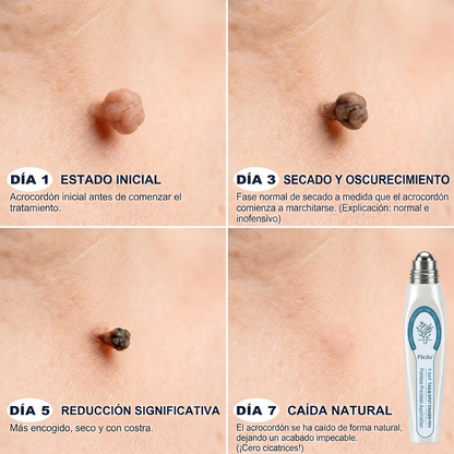 ✒️𝐏𝐢𝐜𝐝𝐨® 𝐁𝐨𝐫𝐫𝐚𝐝𝐨𝐫 𝐝𝐞 𝐕𝐞𝐫𝐫𝐮𝐠𝐚𝐬 𝐲 𝐌𝐚𝐧𝐜𝐡𝐚𝐬 𝐝𝐞 𝟕 𝐃í𝐚𝐬 (Aplicador roll-on: sin dolor ni cicatrices)