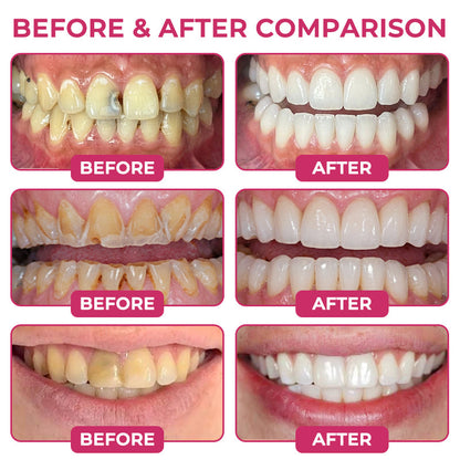 Rolimey® DenPerm Cavity-Repair Natural Enamel Filling Gel💧
