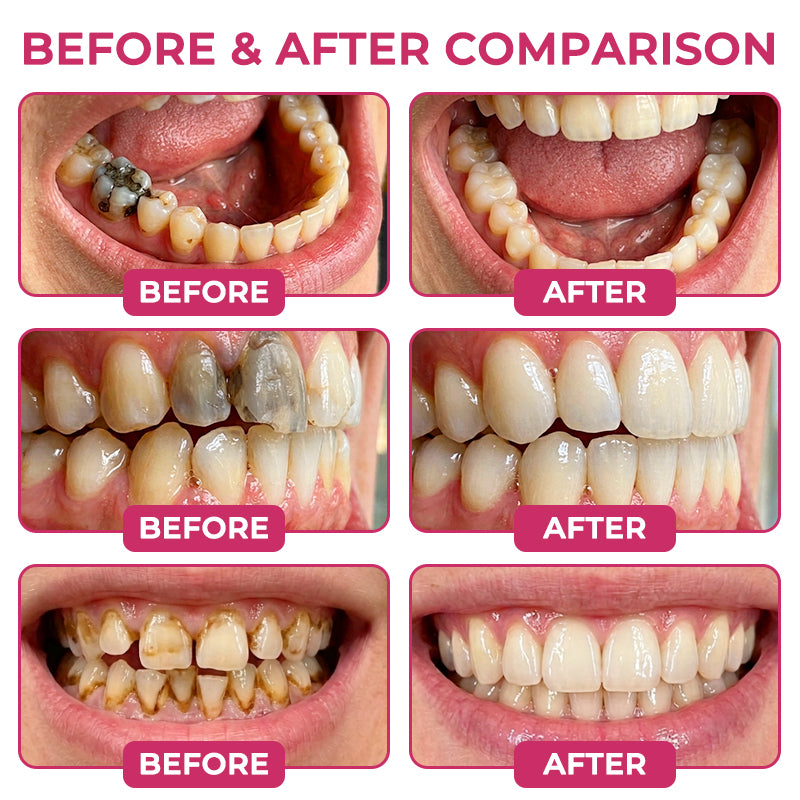 Rolimey® DenPerm Cavity-Repair Natural Enamel Filling Gel💧